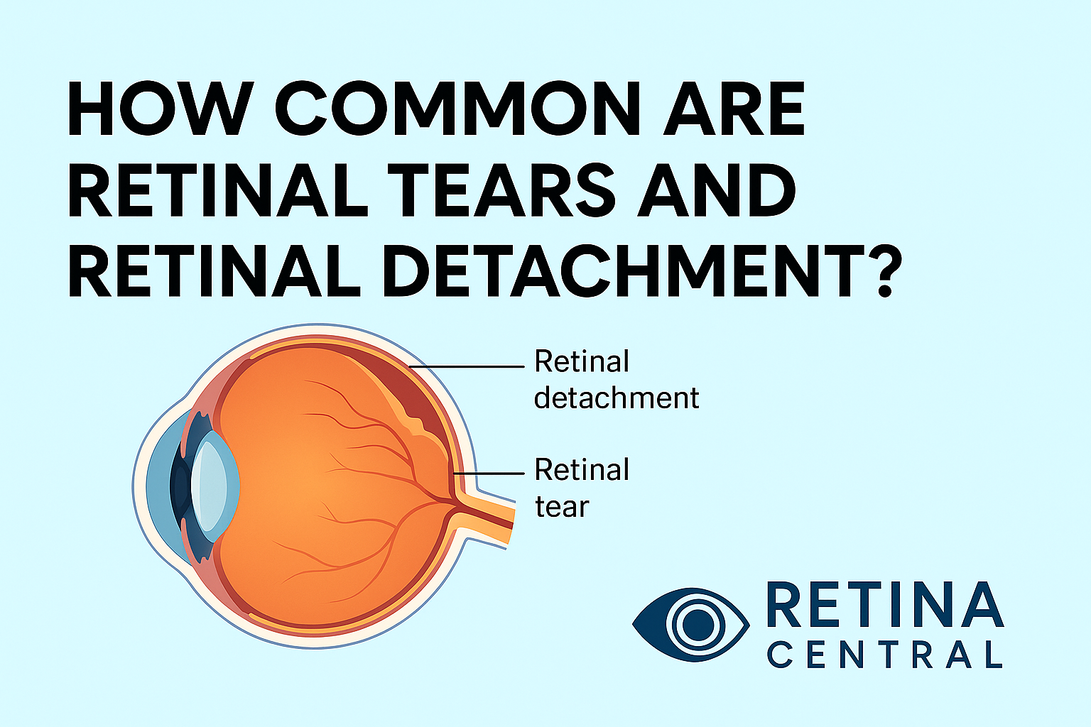 How Common Is Retinal Detachment?